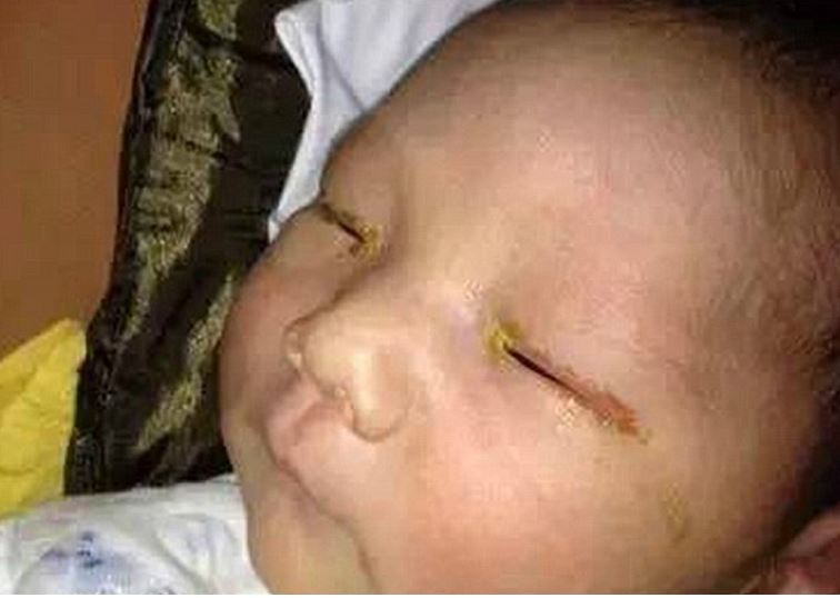 A Camera Flash Damaged an Eye of Three-month Baby