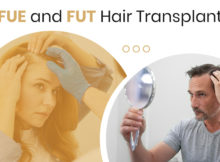 FUE and FUT Hair Transplant