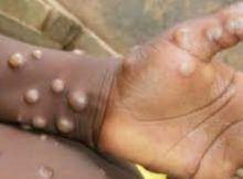 Monkeypox Virus caused 92 confirmed and 28 suspected cases in 12 Countries