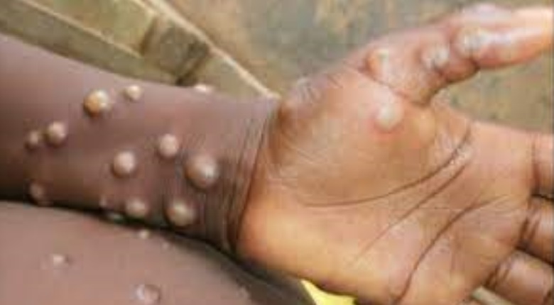 Monkeypox Virus caused 92 confirmed and 28 suspected cases in 12 Countries